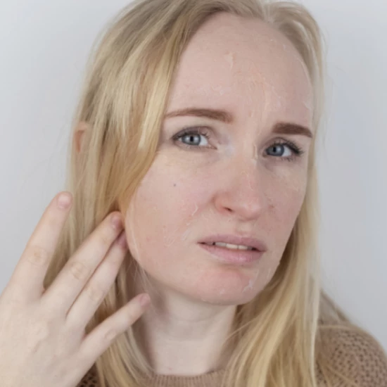 Objawy i sposoby leczenia łuszczycy na twarzy