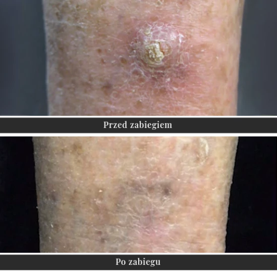 Radioterapia – leczenie nowotworów skóry | Klinika Ambroziak