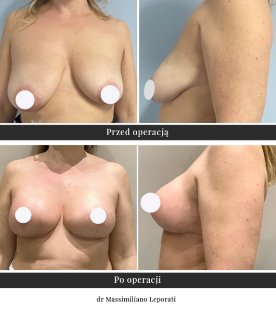 Operacja plastyczna podniesienia biustu z implantami | Klinika Ambroziak