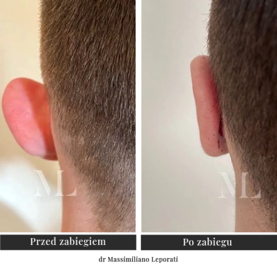 Operacja korekcyjna odstających małżowin usznych - Klinika Ambroziak