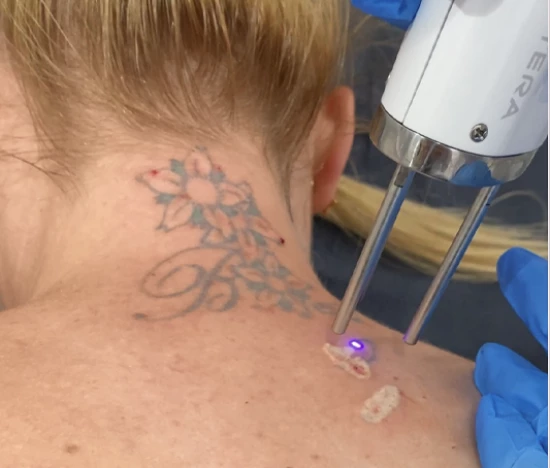 Laser pikosekundowy | Laserowe usuwanie tatuażu w Warszawie | Klinika Ambroziak