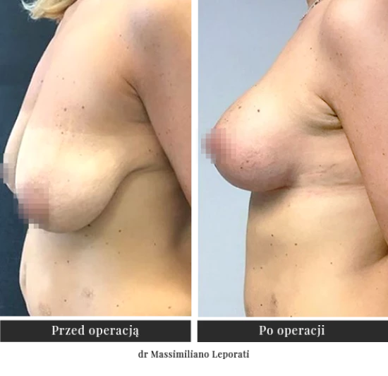 Podniesienie piersi, plastyka i lifting biustu w Warszawie- Klinika Ambroziak