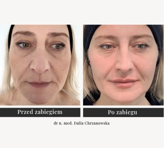 Wolumetria twarzy, modelowanie kwasem hialuronowym | Klinika Ambroziak