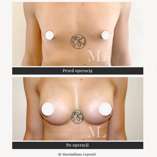 Powiększanie piersi implantami, operacja biustu | Klinika Ambroziak