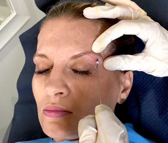 Zabieg foxy eyes z wykorzystaniem nici | Klinika Ambroziak