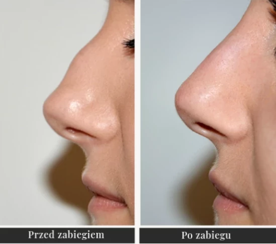 Kwas hialuronowy – modelowanie kształtu nosa - Klinika Ambroziak
