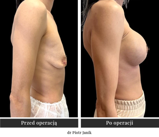 Powiększanie piersi implantami, operacja biustu | Klinika Ambroziak