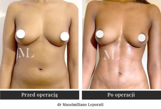 Zabieg liposukcji HD Body Shaping | Klinika Ambroziak