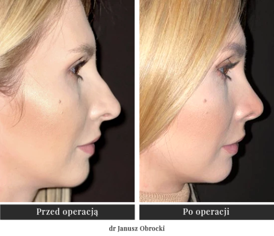 Operacja plastyczna i korekcja operacyjna nosa | Klinika Ambroziak